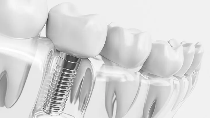 implant disler qiymeti implant dis qiymet implant dişlər diş implantı